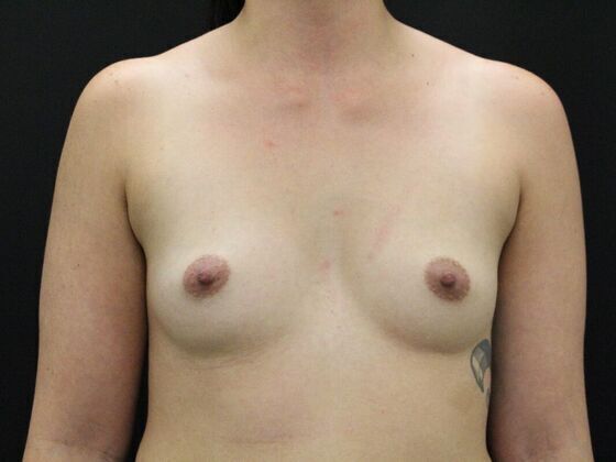 Breast Augmentation Case 7 - Before