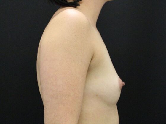 Breast Augmentation: Case 7 - Before