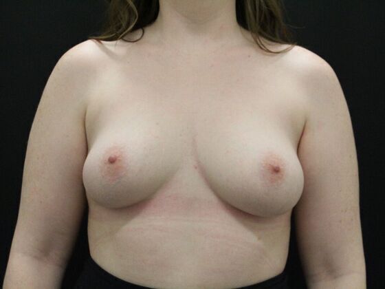 Breast Augmentation Case 8 - Before