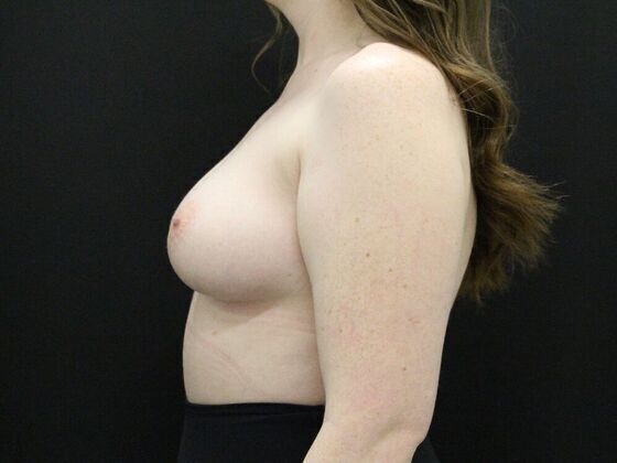 Breast Augmentation: Case 8 - Before