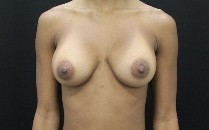 Breast Augmentation Case 9 - After