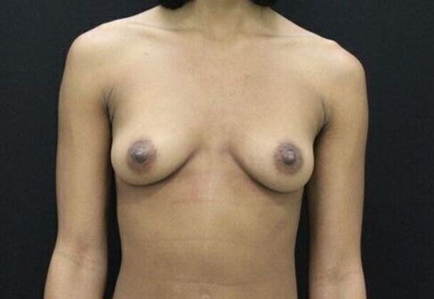 Breast Augmentation Case 9 - Before