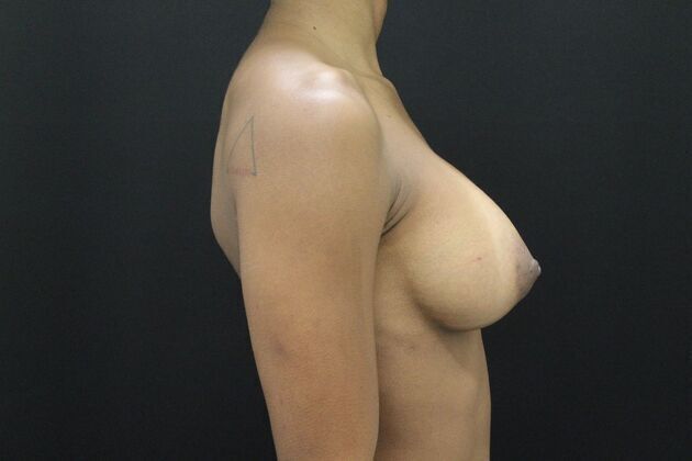 Breast Augmentation: Case 9 - After