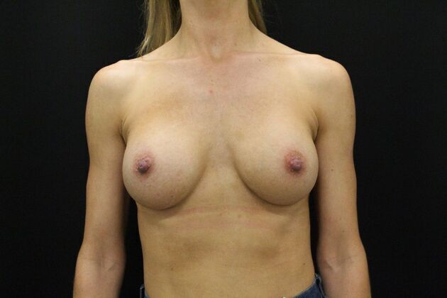Breast Augmentation Case 10 - After