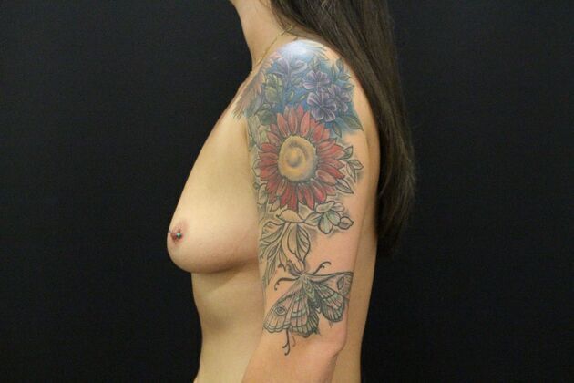 Breast Augmentation: Case 11 - Before