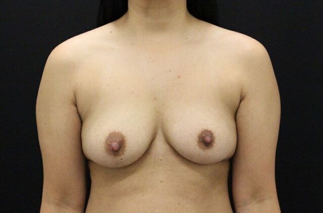 Breast Augmentation Case 12 - Before