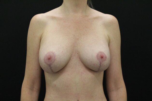 Breast Lift & Breast Lift Augmentation Case 1 - After