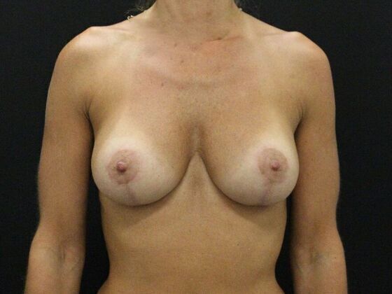 Breast Lift & Breast Lift Augmentation Case 2 - After