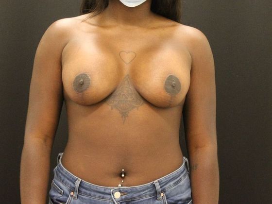 Breast Lift & Breast Lift Augmentation Case 10 - After