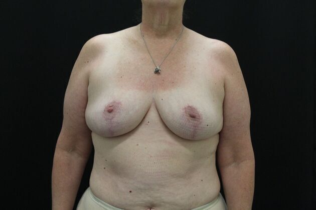 Breast Reduction & Lift Case 2 - After