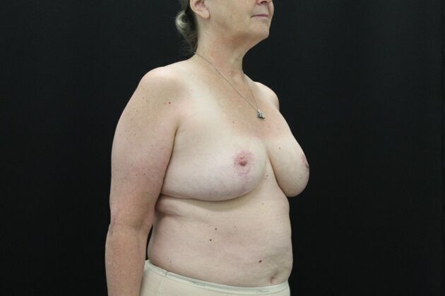 Breast Reduction & Lift: Case 2 - After