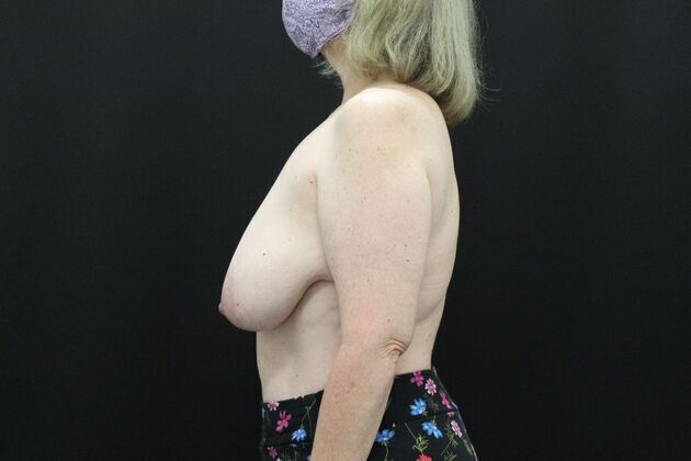 Breast Reduction & Lift: Case 2 - Before