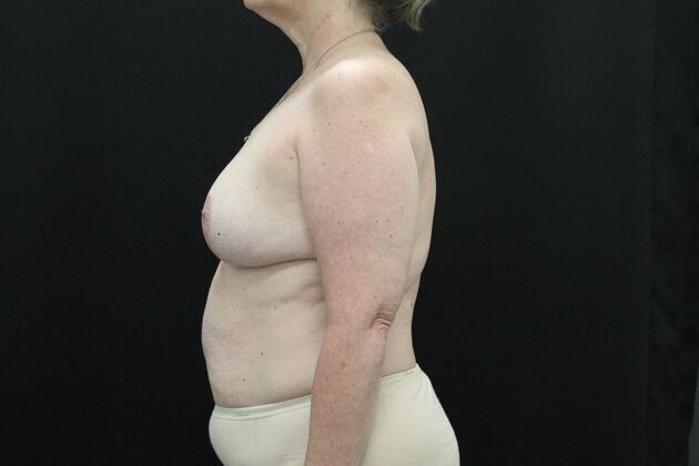 Breast Reduction & Lift: Case 2 - After