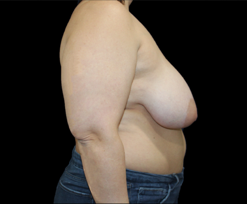 Breast Reduction & Lift: Case 3 - Before
