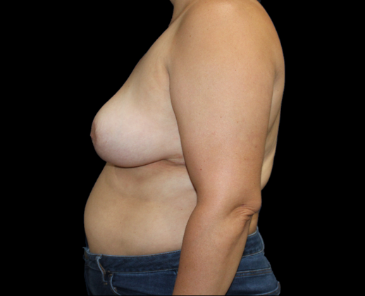 Breast Reduction & Lift: Case 3 - After
