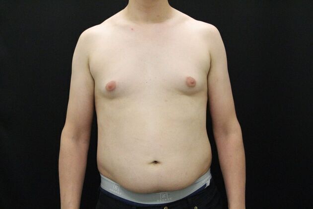 Gynecomastia & Male Breast Reduction Case 1 - Before