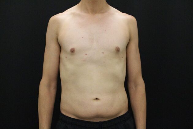Gynecomastia & Male Breast Reduction Case 1 - After