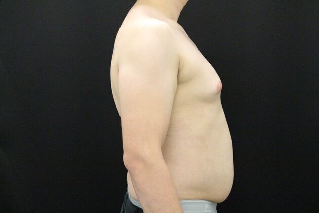 Gynecomastia & Male Breast Reduction: Case 1 - Before