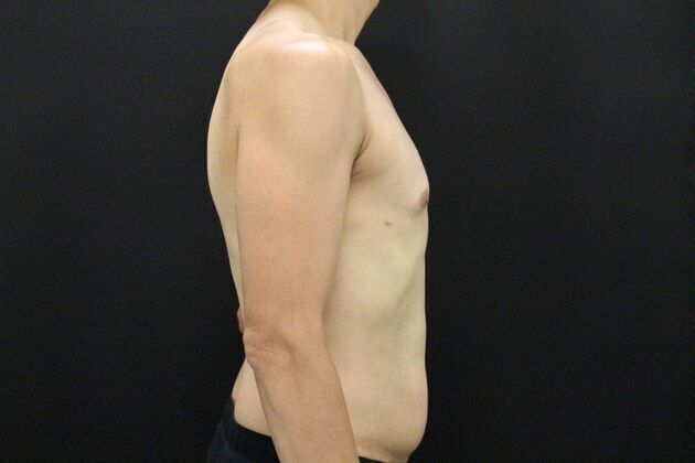 Gynecomastia & Male Breast Reduction: Case 1 - After