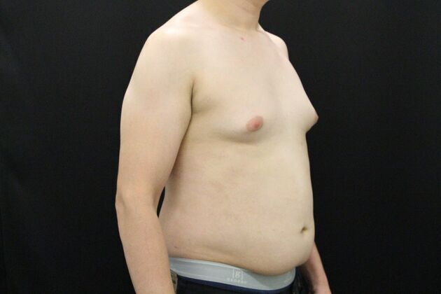 Gynecomastia & Male Breast Reduction: Case 1 - Before