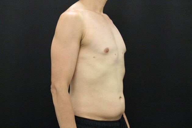 Gynecomastia & Male Breast Reduction: Case 1 - After
