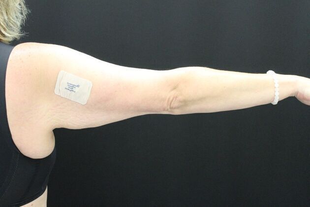 Arm Lift & Reduction Case 1 - Before