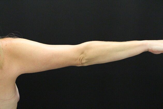 Arm Lift & Reduction Case 1 - After