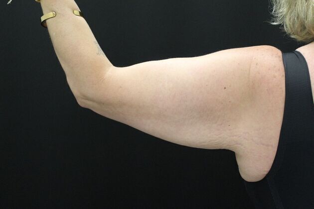 Arm Lift & Reduction: Case 1 - Before