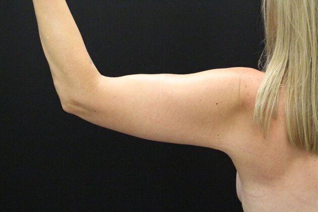 Arm Lift & Reduction: Case 1 - After