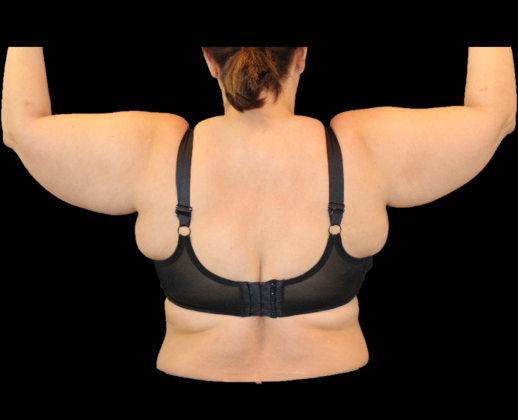 Arm Lift & Reduction Case 2 - Before