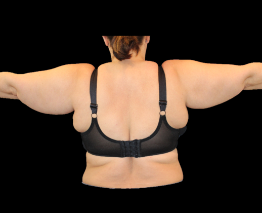 Arm Lift & Reduction: Case 2 - Before