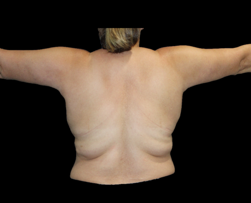 Arm Lift & Reduction: Case 2 - After