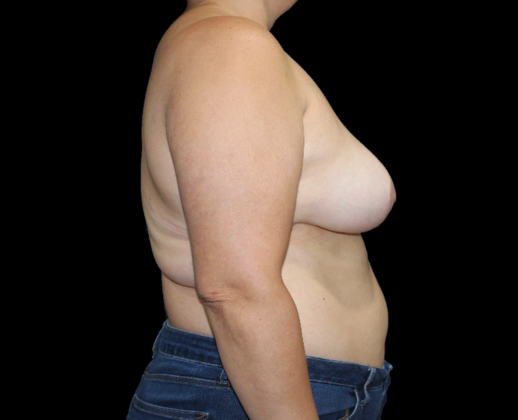 Arm Lift & Reduction: Case 2 - Before