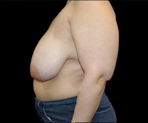 Arm Lift & Reduction: Case 2 - Before