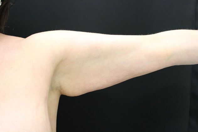 Arm Lift & Reduction Case 3 - Before