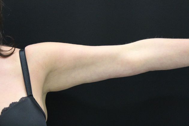 Arm Lift & Reduction Case 3 - After