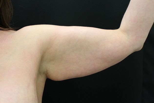 Arm Lift & Reduction: Case 3 - Before