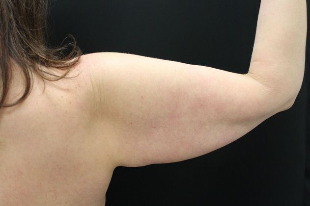 Arm Lift & Reduction: Case 3 - Before