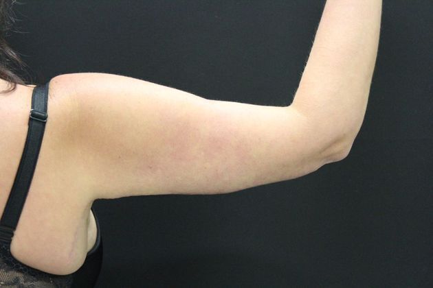 Arm Lift & Reduction: Case 3 - After