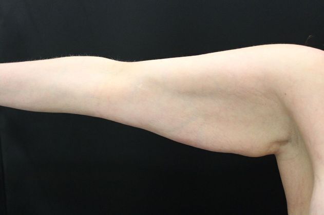 Arm Lift & Reduction: Case 3 - Before