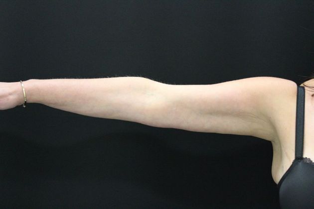Arm Lift & Reduction: Case 3 - After