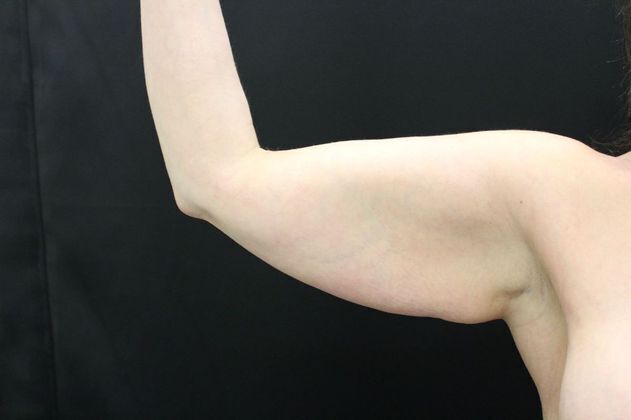 Arm Lift & Reduction: Case 3 - Before