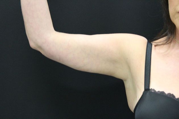 Arm Lift & Reduction: Case 3 - After