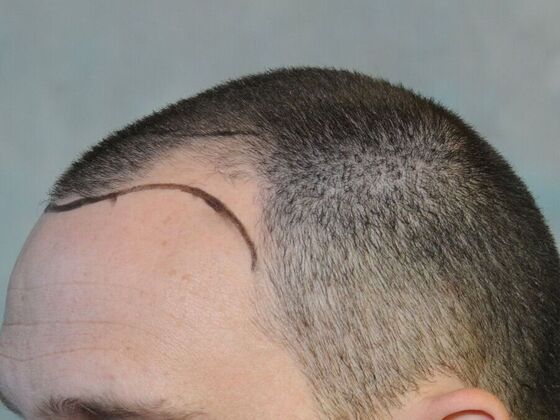 FUT Hair Restoration: Case 30 - Before