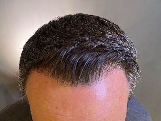 FUT Hair Restoration: Case 30 - After