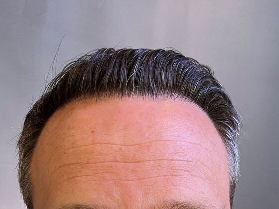 FUT Hair Restoration Case 30 - After