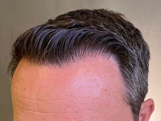 FUT Hair Restoration: Case 30 - After