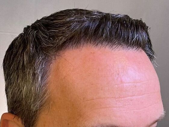 FUT Hair Restoration: Case 30 - After