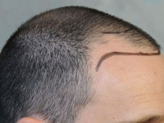 FUT Hair Restoration: Case 30 - Before