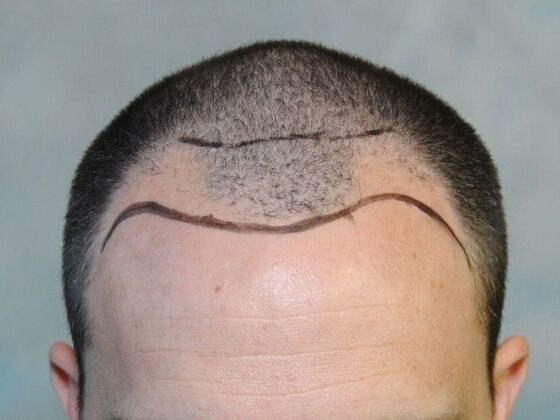 FUT Hair Restoration: Case 30 - Before